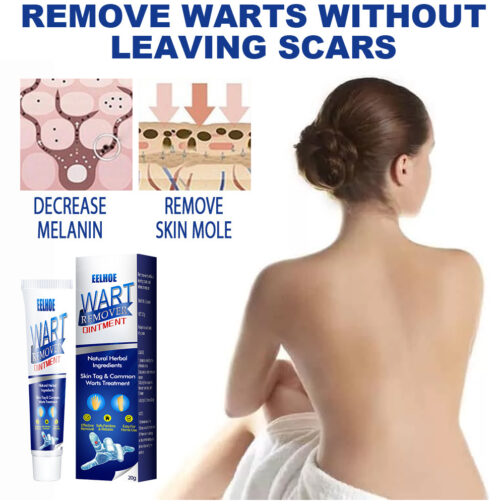 Zhongcao Keyou Liquid Skin Wart Cream – Effective Wart Removal & Skin Care - Image 4